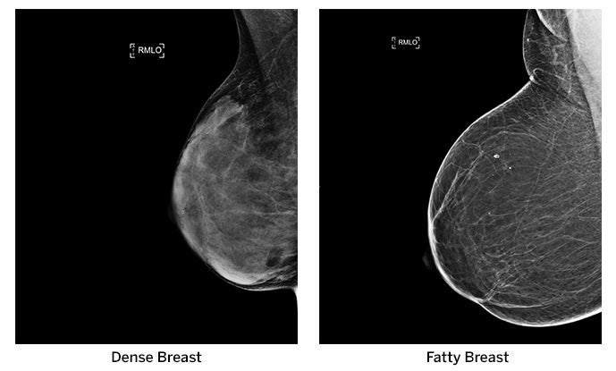 Dense Breast Tissue: What Does it Mean? - Mather Hospital